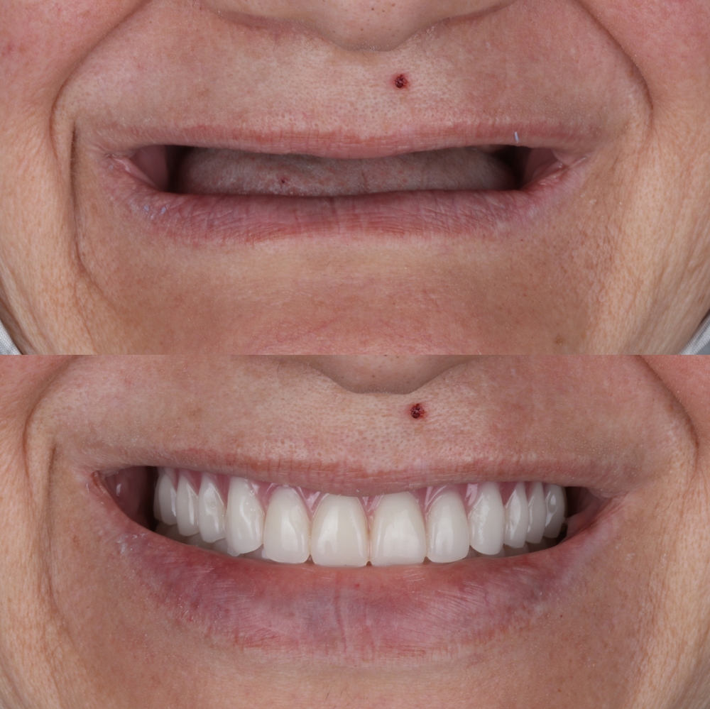 Implante Dentário Antes e Depois – Resultado Natural do Tratamento Vitall Check-Up Odontologia & Saúde Integrativa | Dentista | Mogi das Cruzes