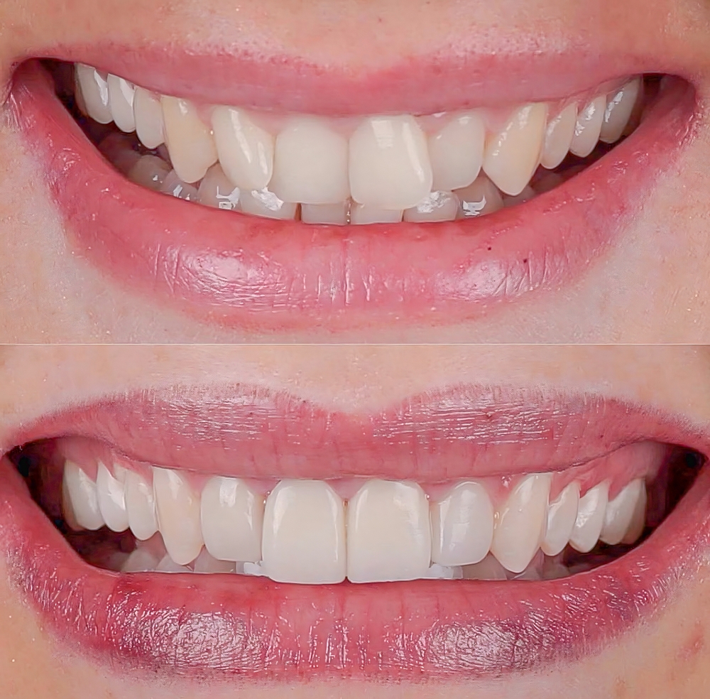 Ortodontista em Mogi das Cruzes Alinhador Invisível Antes e Depois – Sorriso Mais Alinhado e Harmônico Vitall Check-Up Odontologia & Saúde Integrativa | Dentista | Mogi das Cruzes