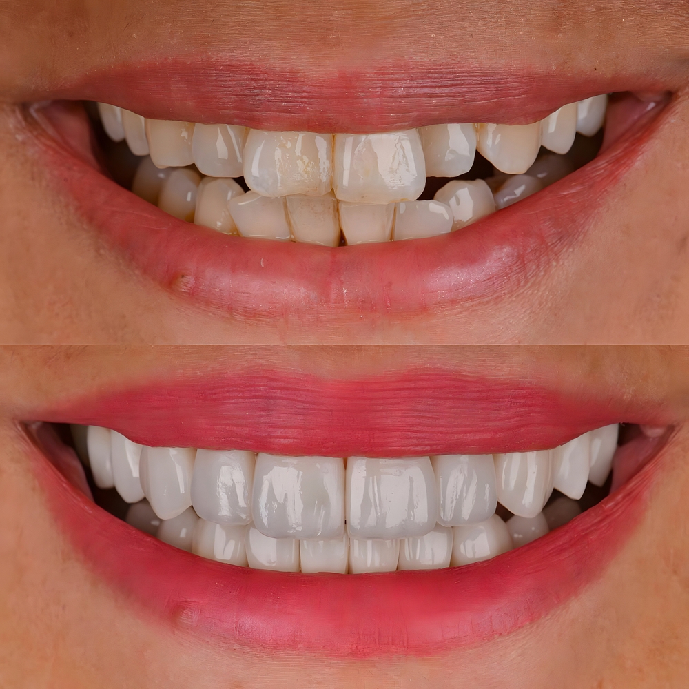 Ortodontista em Mogi das Cruzes Antes e Depois Aparelho Invisível – Correção do Sorriso Vitall Check-Up Odontologia & Saúde Integrativa | Dentista | Mogi das Cruzes