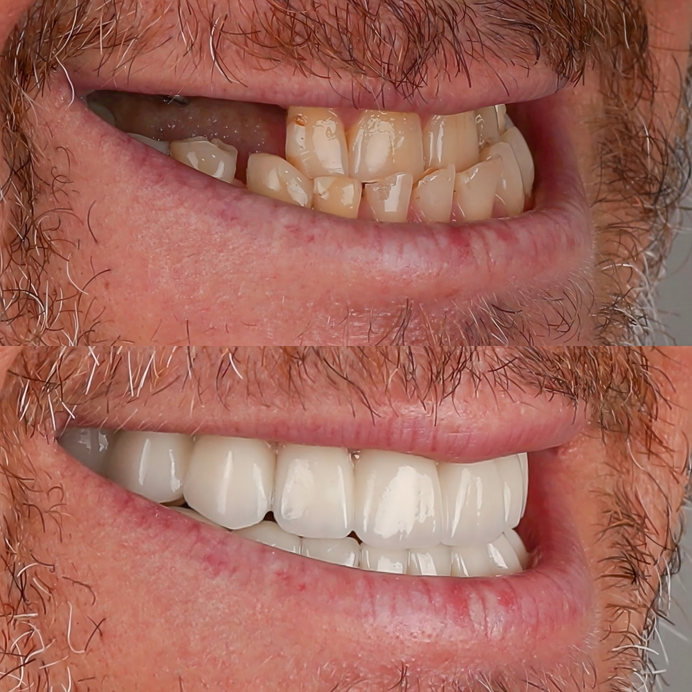 Antes e Depois de Implante Dentário – Recuperação do Sorriso Vitall Check-Up Odontologia & Saúde Integrativa | Dentista | Mogi das Cruzes