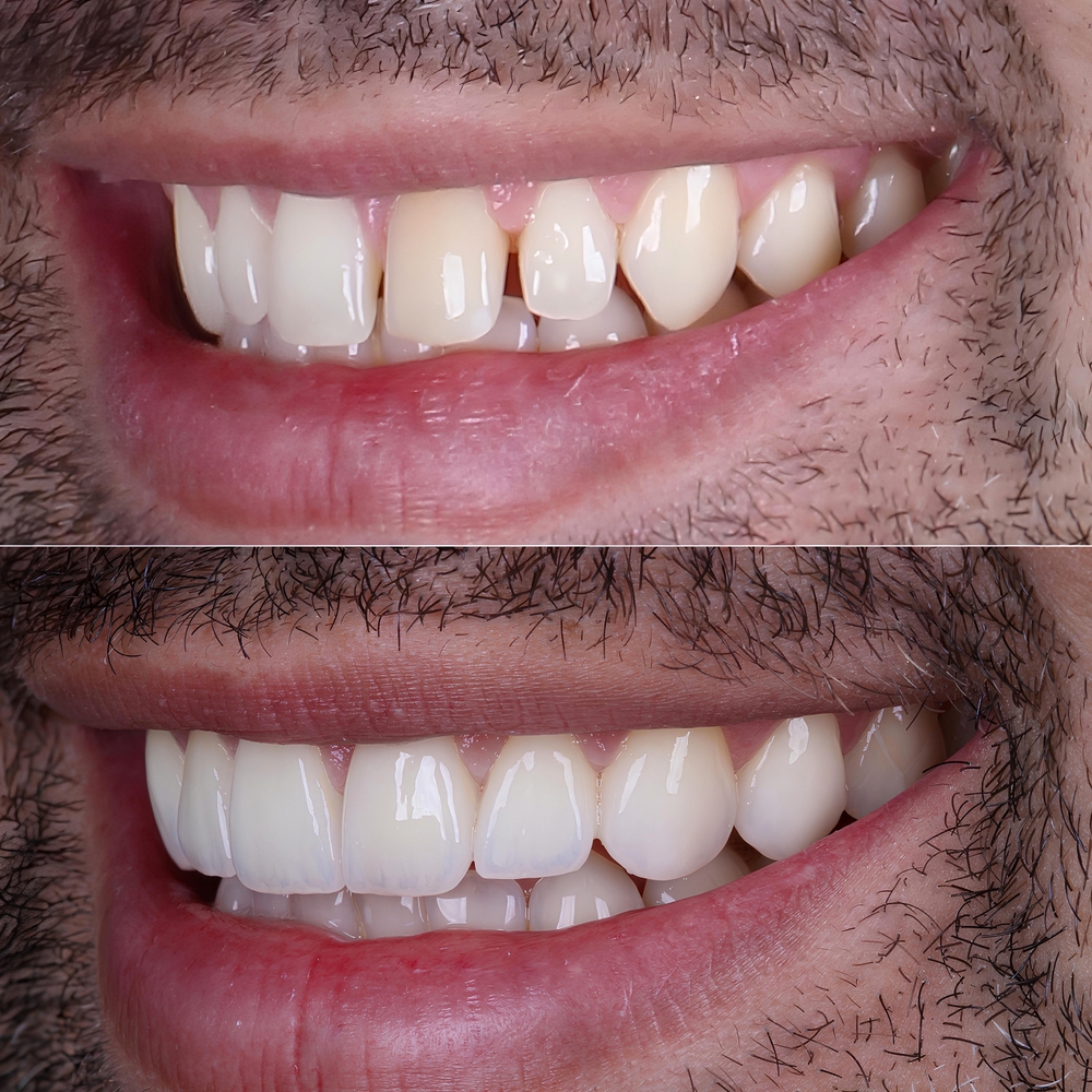 Transformação do Sorriso com Facetas Dentárias – Antes e Depois Vitall Check-Up Odontologia & Saúde Integrativa | Dentista | Mogi das Cruzes
