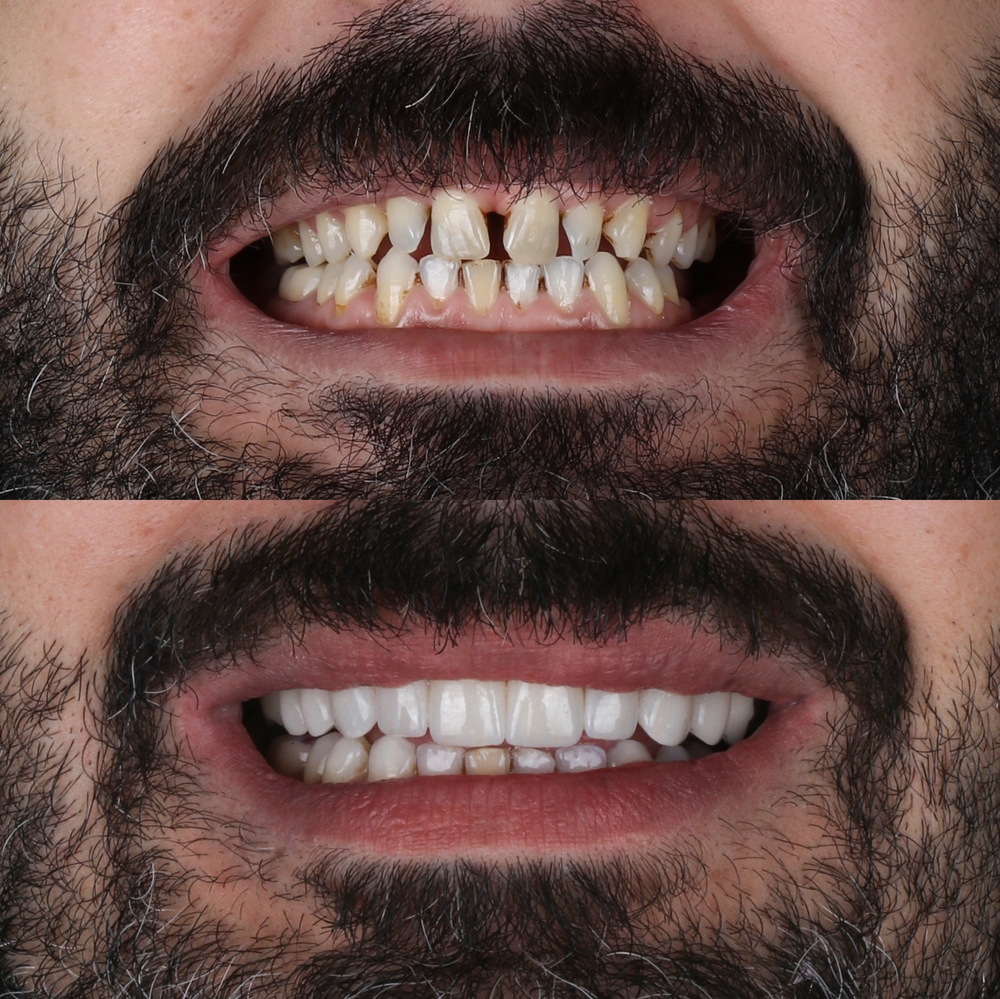 Antes e Depois de Facetas Dentárias – Transformação Completa do Sorriso Vitall Check-Up Odontologia & Saúde Integrativa | Dentista | Mogi das Cruzes