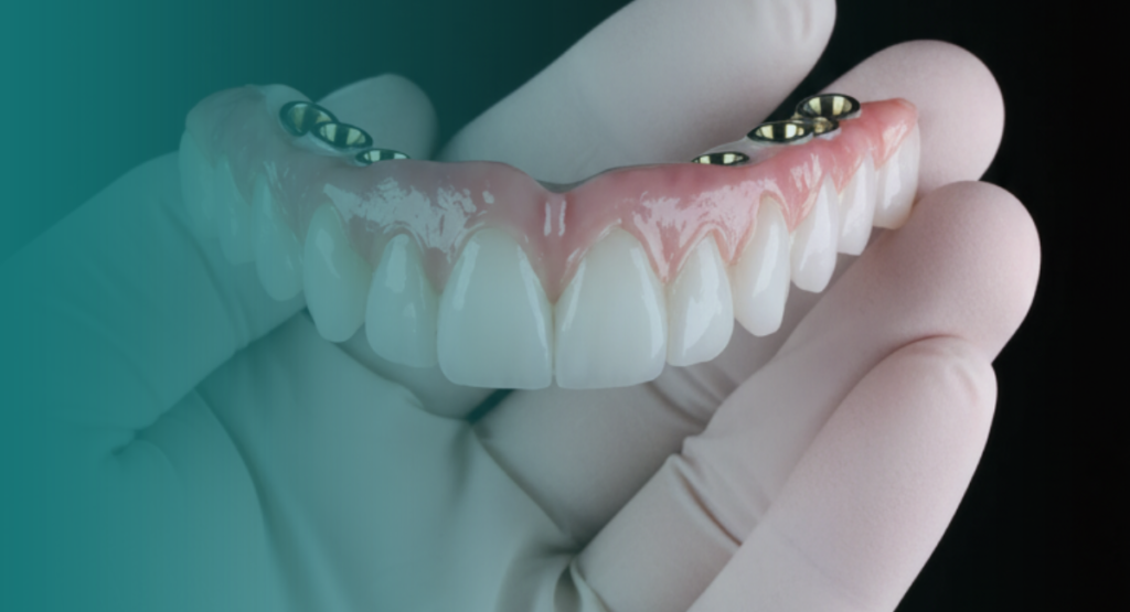 Implantes Protocolo Vitall Check-Up Odontologia & Saúde Integrativa | Dentista | Mogi das Cruzes