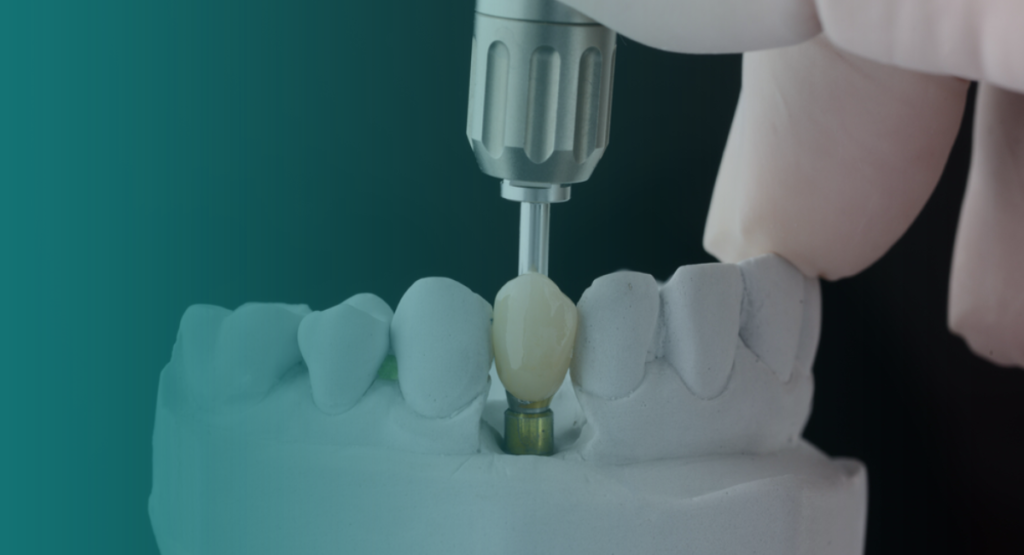 Implantes Unitários Vitall Check-Up Odontologia & Saúde Integrativa | Dentista | Mogi das Cruzes