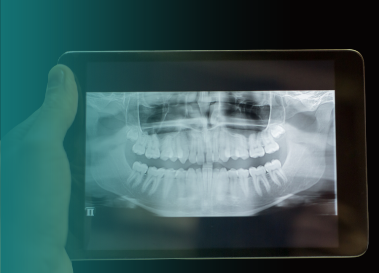 Endodontia Tratamos de canais radiculares com precisão e conforto, preservando seus dentes por mais tempo. Tratamento de Canal: Remoção da polpa infectada e limpeza interna do dente para preservar sua estrutura e evitar extrações. Retratamento Endodôntico: Correção de tratamentos anteriores de canal que apresentaram complicações. Cirurgia Endodôntica: Procedimentos cirúrgicos, como apicectomia, para tratar infecções na raiz. Vitall Check-Up Odontologia & Saúde Integrativa | Dentista | Mogi das Cruzes