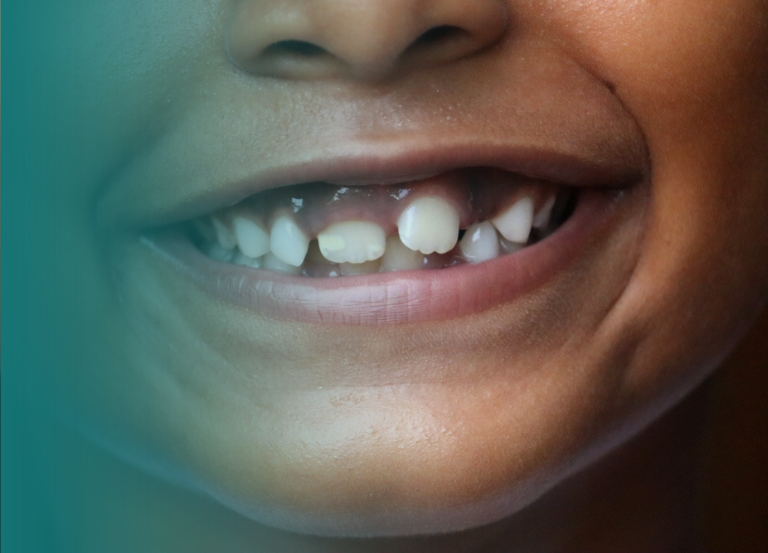 Odontopediatria Cuidamos da saúde bucal dos pequenos com carinho e atenção, oferecendo tratamentos preventivos e corretivos desde cedo. Avaliação e Diagnóstico Precoce: Exame detalhado para identificar problemas dentários e de desenvolvimento da arcada, permitindo o planejamento de tratamentos preventivos e corretivos. Prevenção e Educação Bucal: Aplicação de flúor, selantes dentários e orientação sobre higiene bucal para prevenir cáries e promover hábitos saudáveis desde a infância. Tratamentos Restauradores e Ortodontia Preventiva: Correção de cáries, tratamentos de canal em dentes de leite e uso de aparelhos funcionais para alinhar a mordida e os dentes em desenvolvimento. Vitall Check-Up Odontologia & Saúde Integrativa | Dentista | Mogi das Cruzes