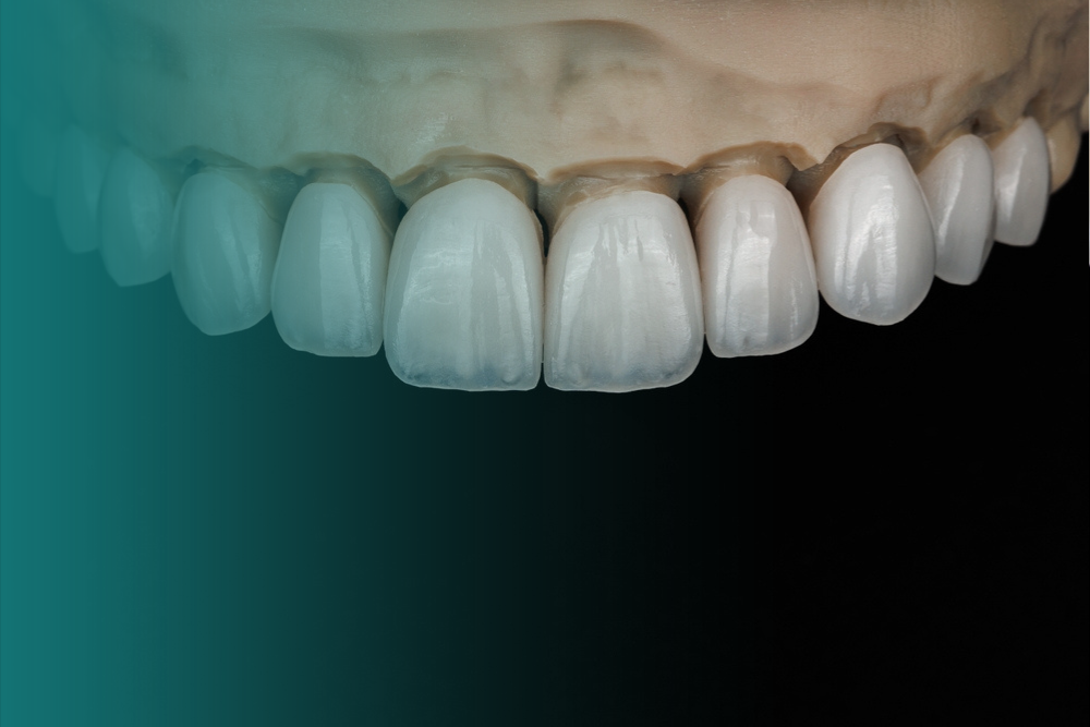 Facetas de Resina, Porcelana e Lentes de Contato Dental em Mogi das Cruzes​ Vitall Check-Up Odontologia & Saúde Integrativa | Dentista | Mogi das Cruzes