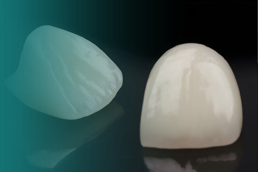 Facetas e Lentes Dentárias Vitall Check-Up Odontologia & Saúde Integrativa | Dentista | Mogi das Cruzes