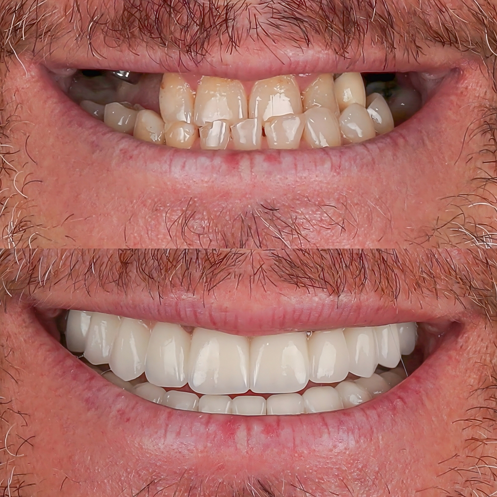 Resultado de Implante Dentário – Antes e Depois do Tratamento Vitall Check-Up Odontologia & Saúde Integrativa | Dentista | Mogi das Cruzes