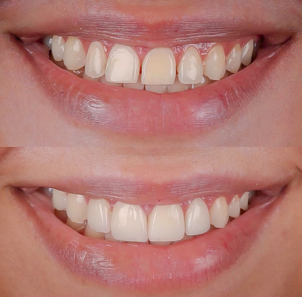 Ortodontista em Mogi das Cruzes Antes e Depois do Alinhador Invisível – Transformação do Sorriso Vitall Check-Up Odontologia & Saúde Integrativa | Dentista | Mogi das Cruzes