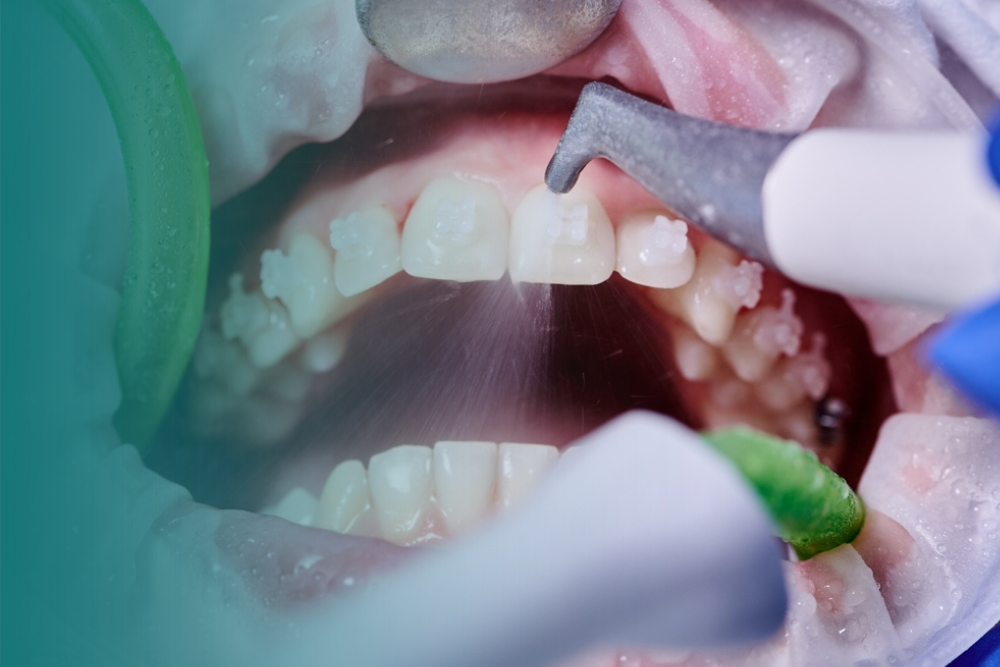 Profilaxia dental e limpeza profissional dos dentes realizada na Vitall em Mogi das Cruzes