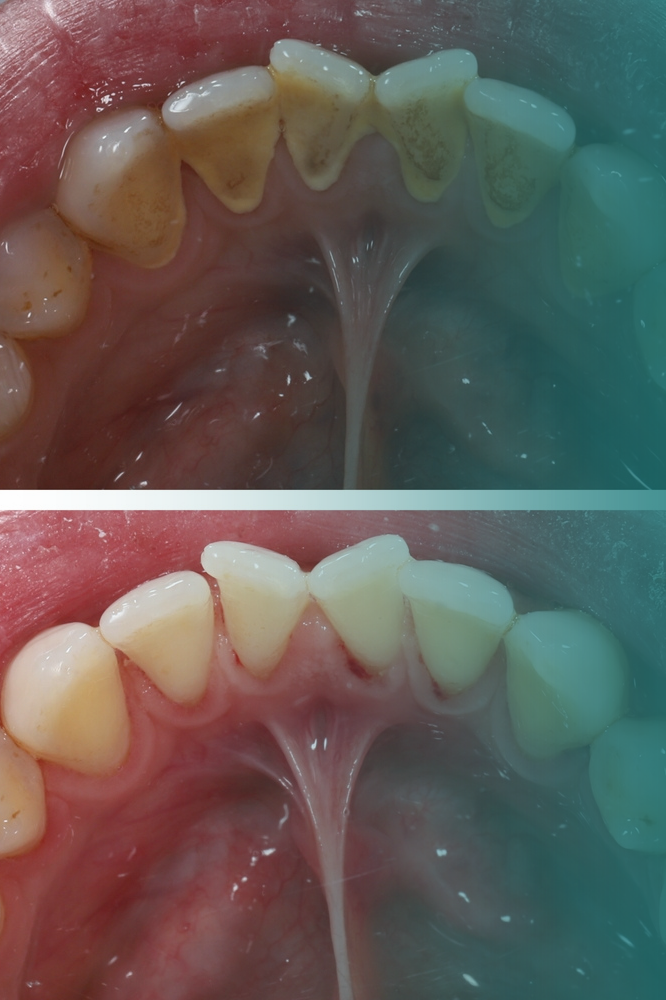 Profilaxia Dental em Mogi das Cruzes | Limpeza Profissional dos Dentes - Vitall Odontologia & Saúde Integrativa | Dentista Mogi das Cruzes